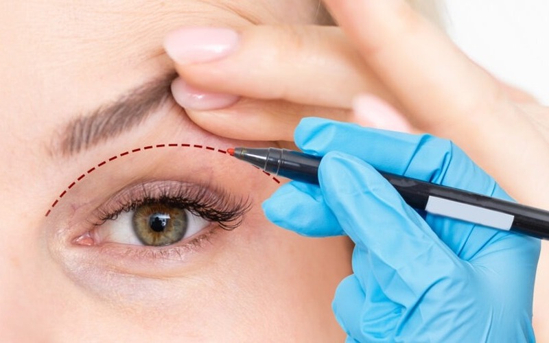 Chỉnh sửa mí mắt (Nguồn: Internet)