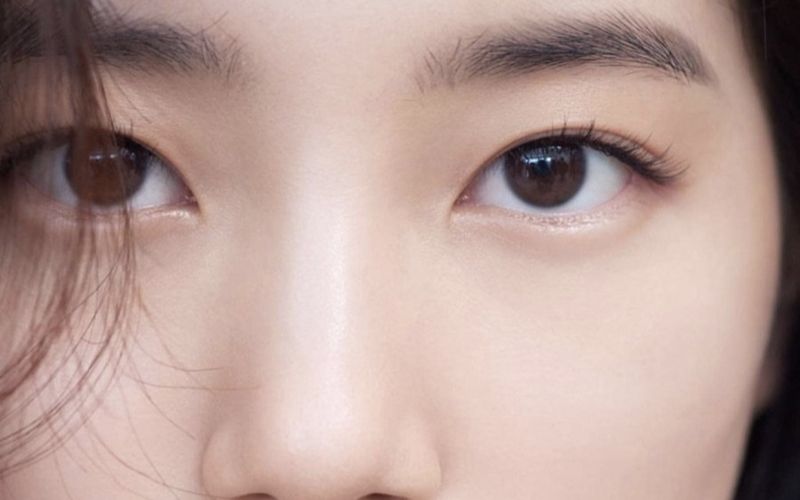 Mắt mí lót nên chỉnh mí (Nguồn: Internet)