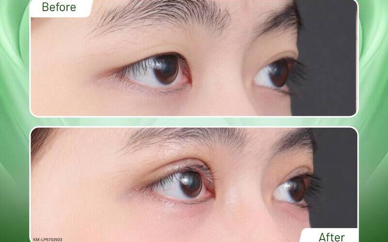 Chỉnh mí mắt tại Thẩm mỹ MD Change Life (Nguồn: Thẩm mỹ MD Change Life)