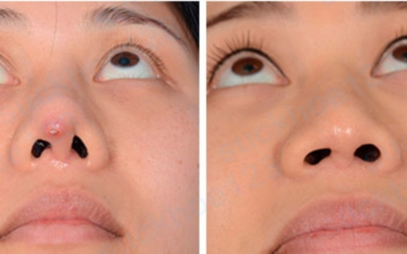 Tình trạng mũi bị lộ sụn, bóng đỏ đầu mũi (Nguồn: Internet)