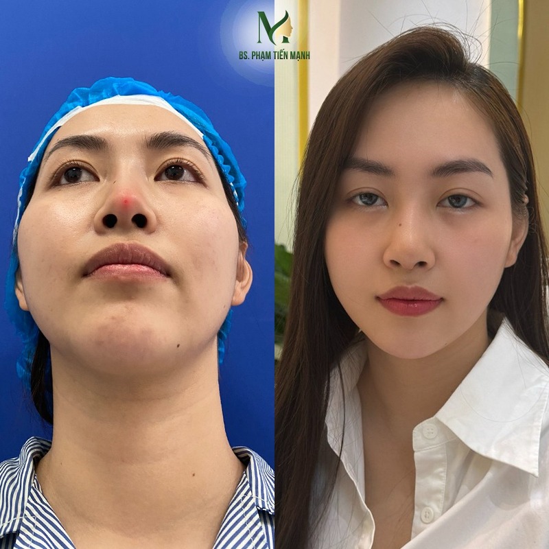 Hình ảnh khách hàng sửa mũi hỏng thành công tại MD Change Life ( Nguồn: MD Change Life )