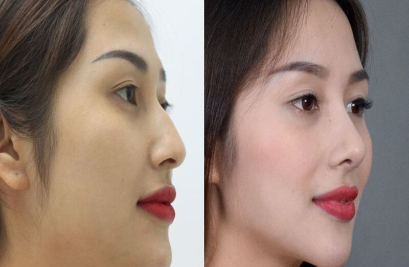 Chỉnh dáng mũi gồ tại MD Change Life - Viện thẩm mỹ uy tín tại Hà Nội (Nguồn: Internet)