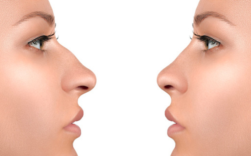 Tìm hiểu địa chỉ chỉnh xương mài gồ mũi Hà Nội (Nguồn: Internet)