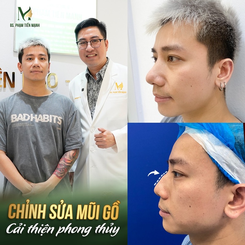 6 Địa Chỉ Chỉnh Xương Mài Gồ Mũi Hà Nội Uy Tín Nhất