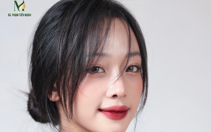 Sửa đầu mũi bị lệch sau nâng tại MD Change Life (Nguồn: MD Change Life)