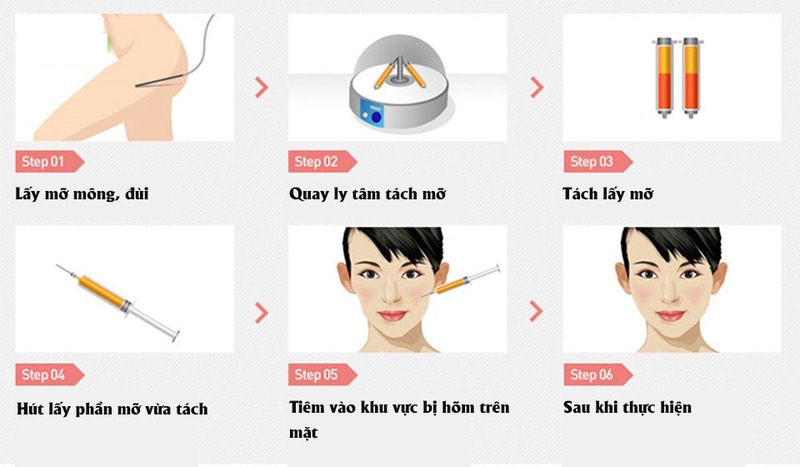 Giá cấy mỡ tự thân lên mặt 2024