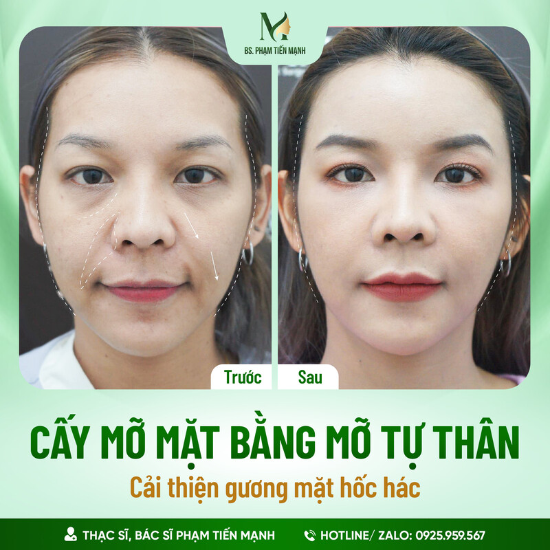 Giá cấy mỡ tự thân lên mặt 2024