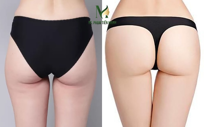 Nâng mông tại Thẩm mỹ MD Change Life (Nguồn: MD Change Life)