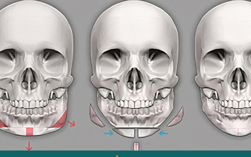 Gọt hàm (Nguồn: Internet)