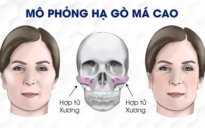 Hạ gò má (Nguồn: Internet)