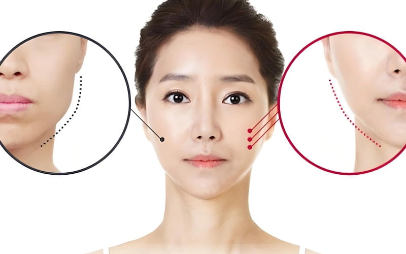 Quy trình gọt hàm, hạ gò má (Nguồn: Internet)