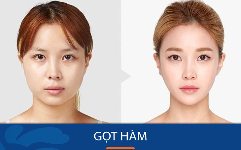 5 địa chỉ gọt hàm Hà Nội uy tín nhất