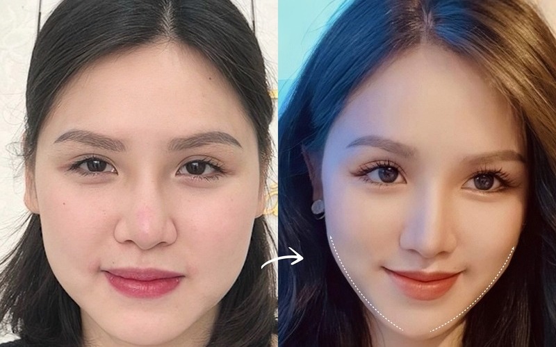 5 địa chỉ gọt hàm Hà Nội uy tín nhất