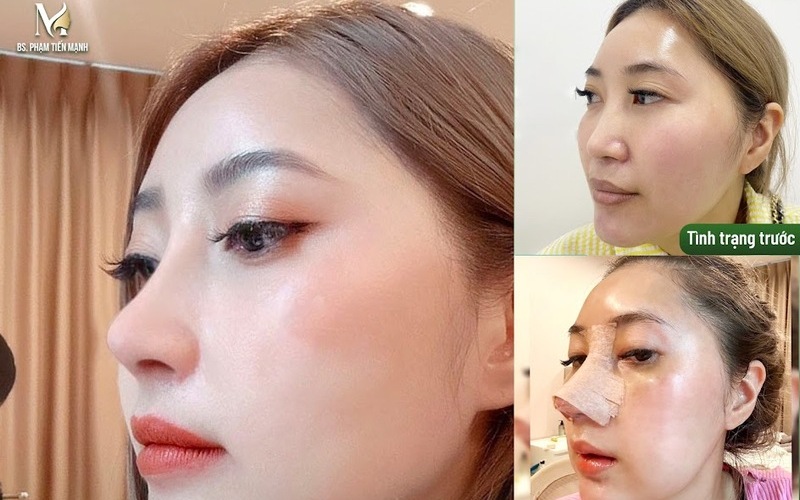 Làm mũi tại Thẩm mỹ MD Change Life (Nguồn: MD Change Life)