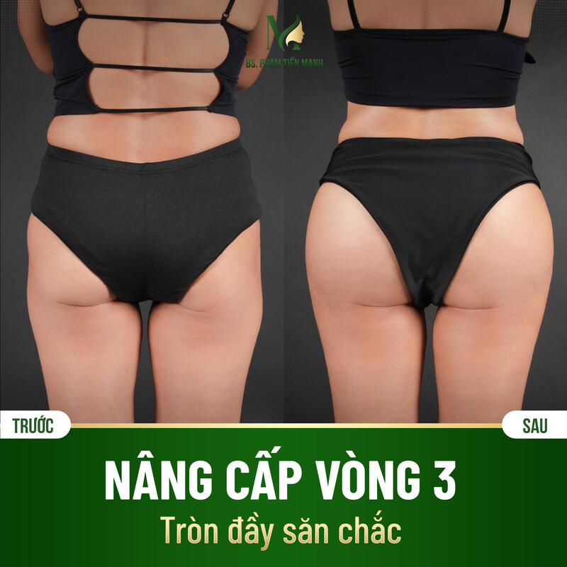 Nâng cấp vòng 3 ưng ý tại MD Change Life ( Nguồn: MD Change Life )