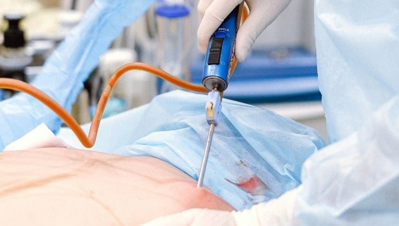 Hút mỡ (Nguồn: Internet)