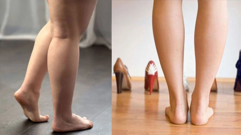 Hút mỡ bắp chân là gì? (Nguồn: Internet)