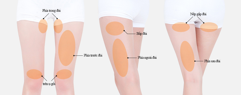 Quy trình thực hiện hút mỡ bắp chân (Nguồn: Internet)