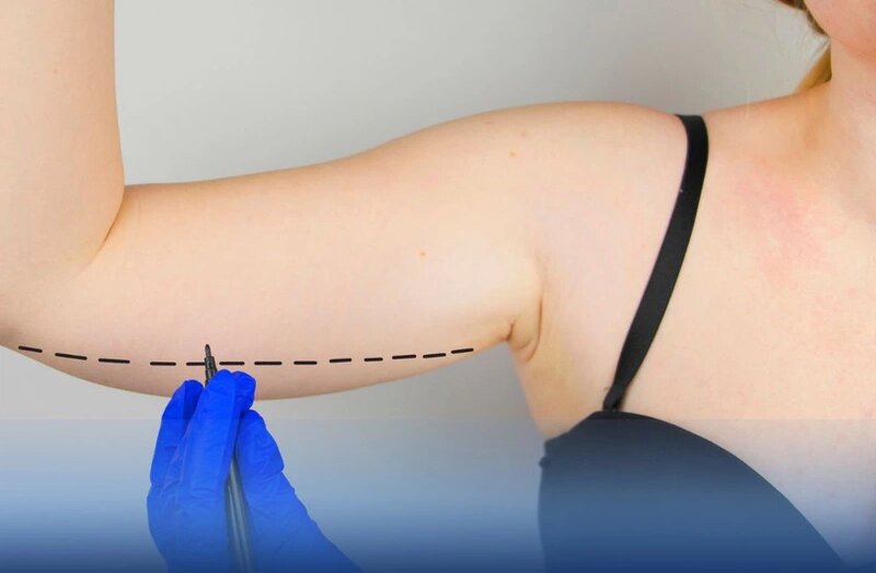 Hút mỡ bắp tay đang dần được phổ biến rộng rãi (Nguồn: Internet)