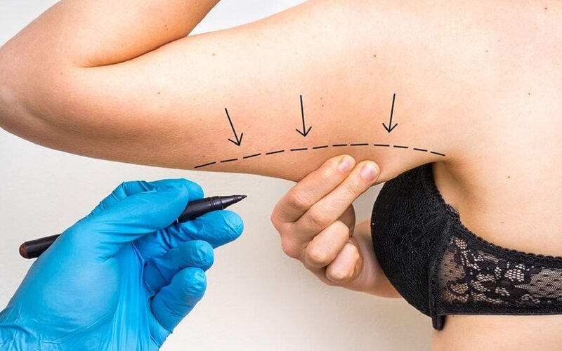 Phương pháp hút mỡ bắp tay dần được chị em biết đến rộng rãi (Nguồn: Internet)