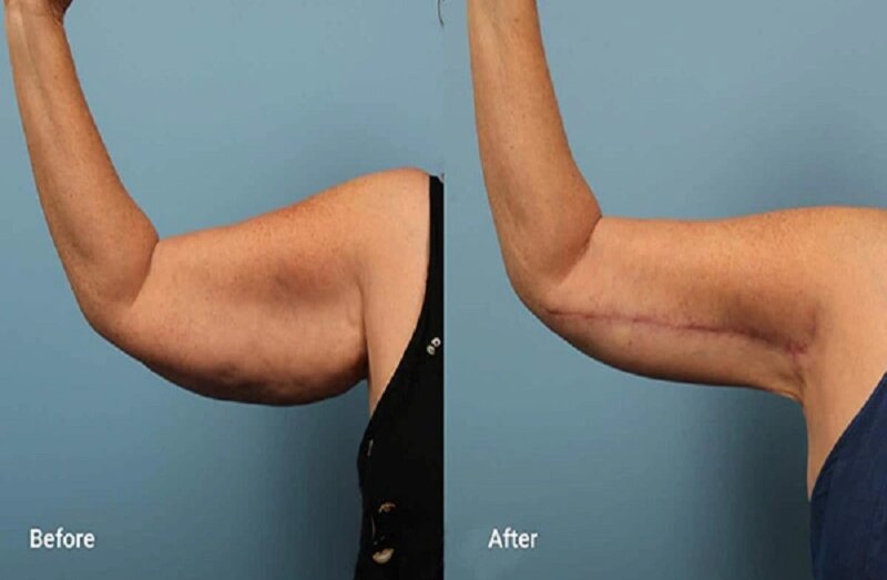 Đến Thẩm mỹ MD Change Life để được hút mỡ bắp tay với mức giá hợp lý (Nguồn: Internet)