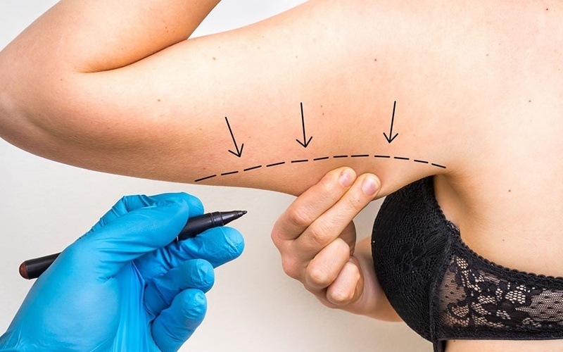 Hút mỡ bắp tay có nguy hiểm không?