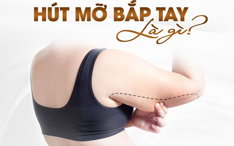 Hút mỡ bắp tay Hà Nội tại Nagami (Nguồn: Internet)