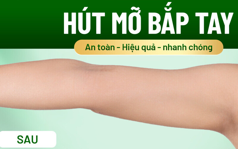 Hút mỡ bắp tay (Nguồn: MD Change Life)