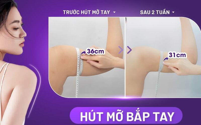 Hút mỡ bắp tay tại Lavian (Nguồn: Internet)