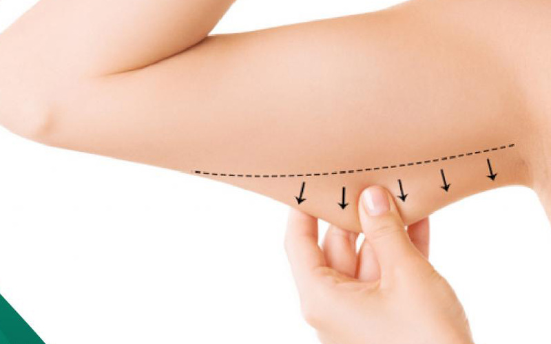 Hút mỡ bắp tay tại Nevada (Nguồn: Internet)