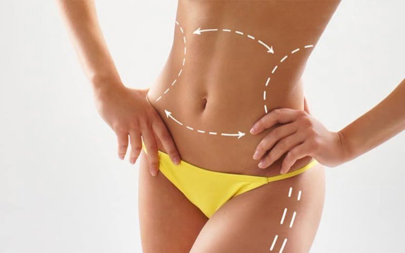 Dáng đẹp sau hút mỡ body (Nguồn: Internet)