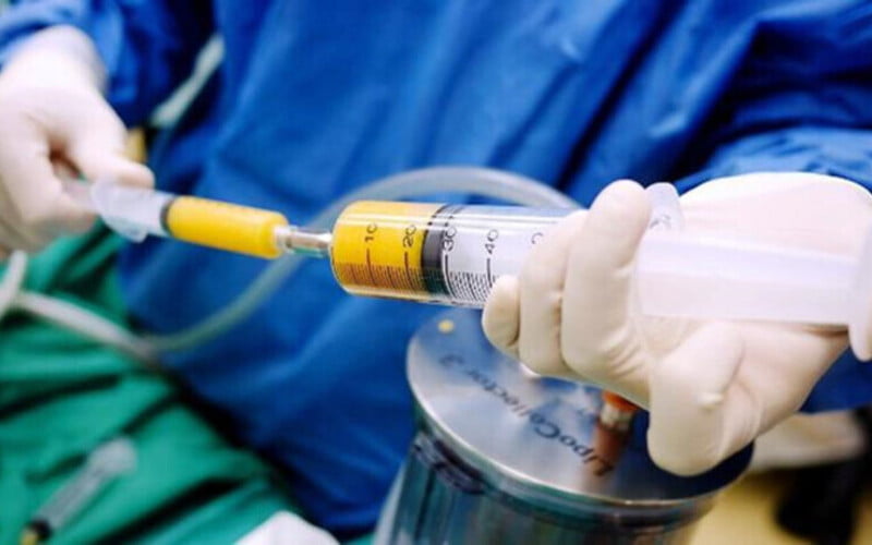 Hút mỡ body nội soi (Nguồn: Internet)