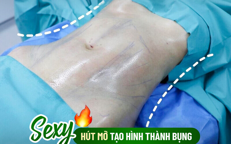 Kết quả hút mỡ body Hà Nội tại MD Change Life (Nguồn: MD Change Life)