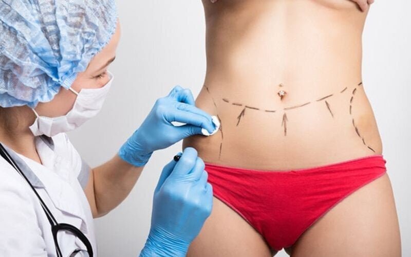 Hút mỡ bụng mang lại nhiều ưu điểm vượt trội, giúp loại bỏ mỡ thừa hiệu quả, tăng cường sự tự tin (Nguồn: Internet)