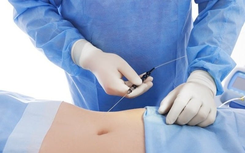 Phương pháp hút mỡ truyền thống (Nguồn: Internet)