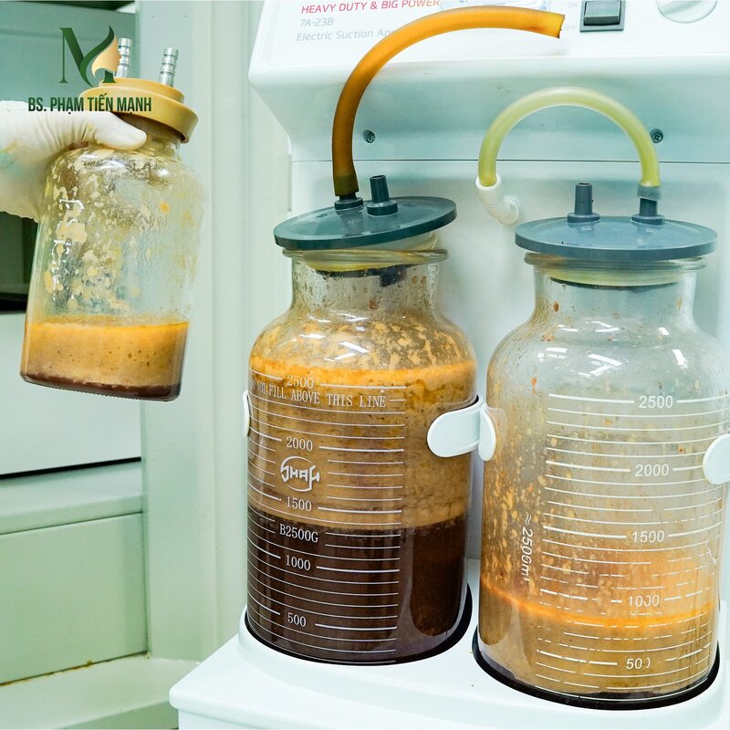 Tìm hiểu nguyên nhân hút mỡ bụng bị lồi lõm (Nguồn: MD Change Life)