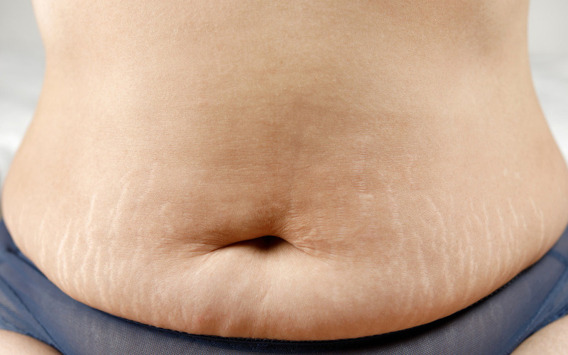 Hậu quả của hút mỡ bụng bị lồi lõm (Nguồn: Internet)