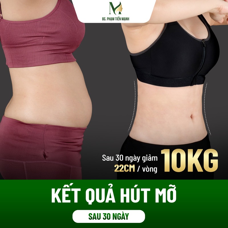 Hút mỡ bụng bị lồi lõm: Nguyên nhân và cách phòng tránh