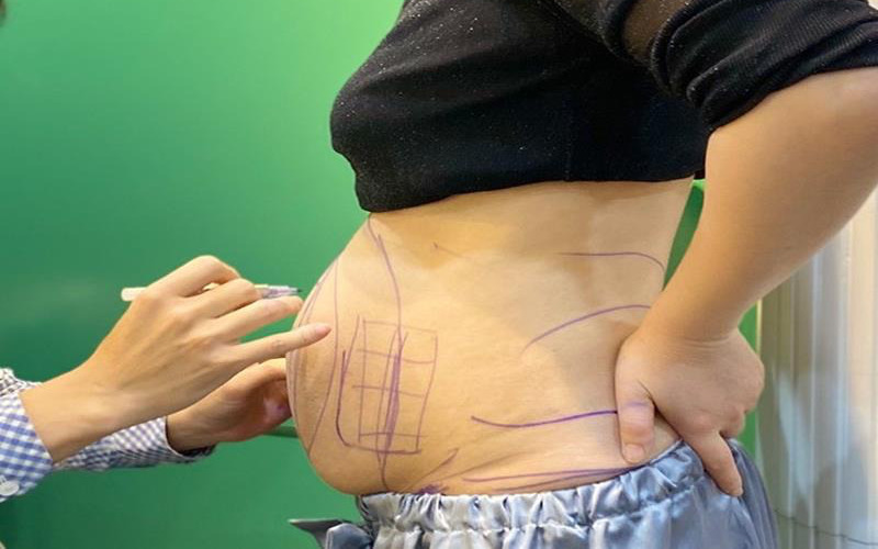 Top 5 Địa Chỉ Hút Mỡ Bụng Hà Nội Uy Tín Nhất 2024