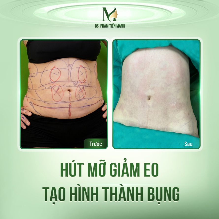 Top 5 Địa Chỉ Hút Mỡ Bụng Hà Nội Uy Tín Nhất 2024