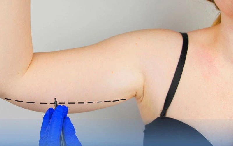 Hút mỡ cánh tay là phương pháp thẩm mỹ sử dụng công nghệ hiện đại để loại bỏ mỡ thừa tích tụ ở vùng bắp tay, giúp thon gọn và săn chắc hơn (Nguồn: Internet)