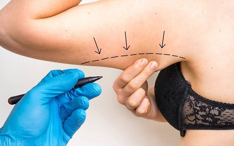 Quy trình hút mỡ cánh tay (Nguồn: Internet)
