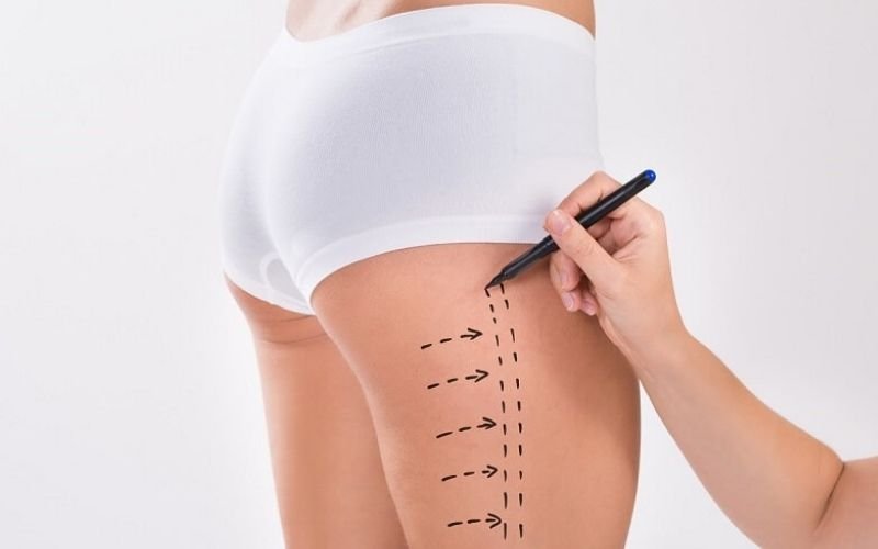 Hút mỡ đùi là công nghệ giảm mỡ giúp giải quyết những mô mỡ thừa ở đùi, hông,… (Nguồn: Internet)