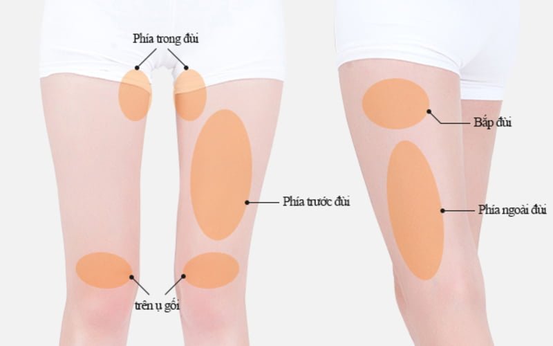 Một số biến chứng có thể xảy ra sau khi hút mỡ đùi (Nguồn: Internet)