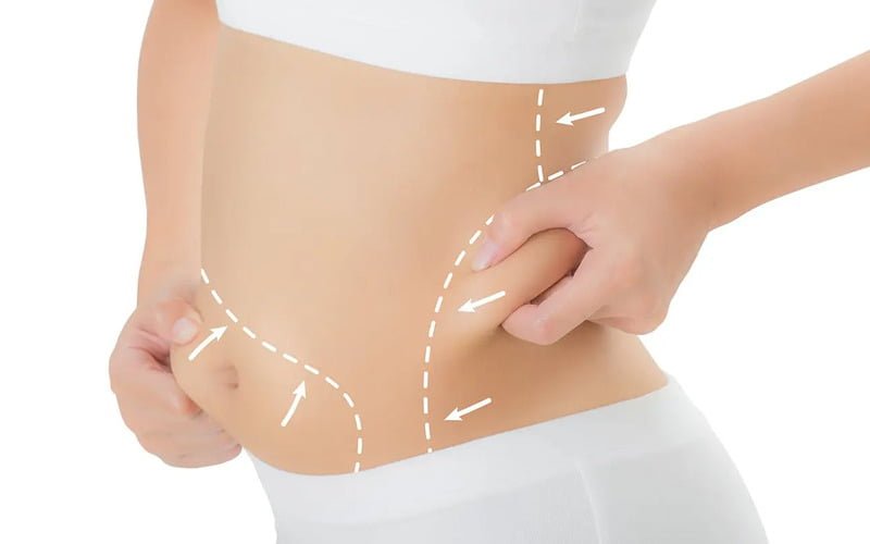 Hút mỡ eo sau là một thủ thuật thẩm mỹ sử dụng công nghệ tiên tiến để loại bỏ mỡ thừa ở vùng eo sau (Nguồn: Internet)