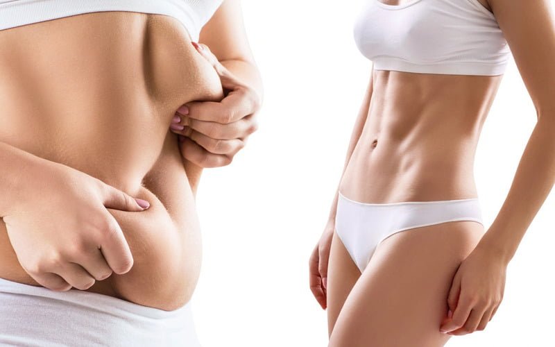Ai nên và không nên hút mỡ eo sau? (Nguồn: Internet)