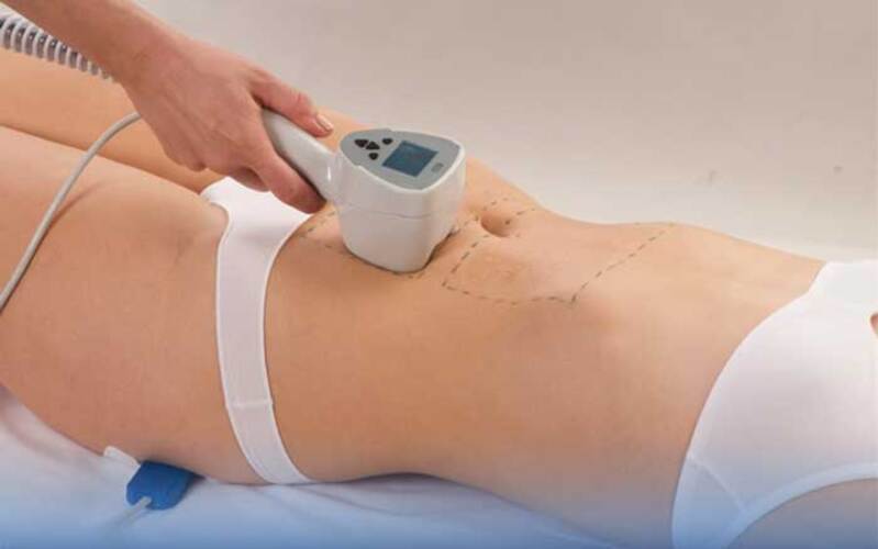 Hút mỡ bằng sóng siêu âm (Nguồn: Internet)