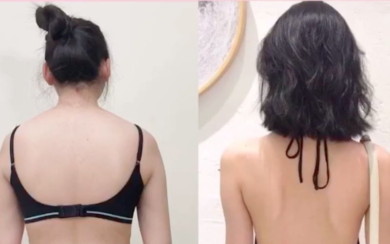 Hút mỡ lưng (Nguồn: Internet)