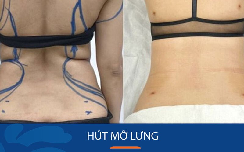 Quy trình hút mỡ lưng (Nguồn: Internet)
