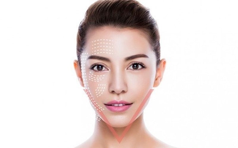 Hút mỡ mặt (Nguồn: Internet)